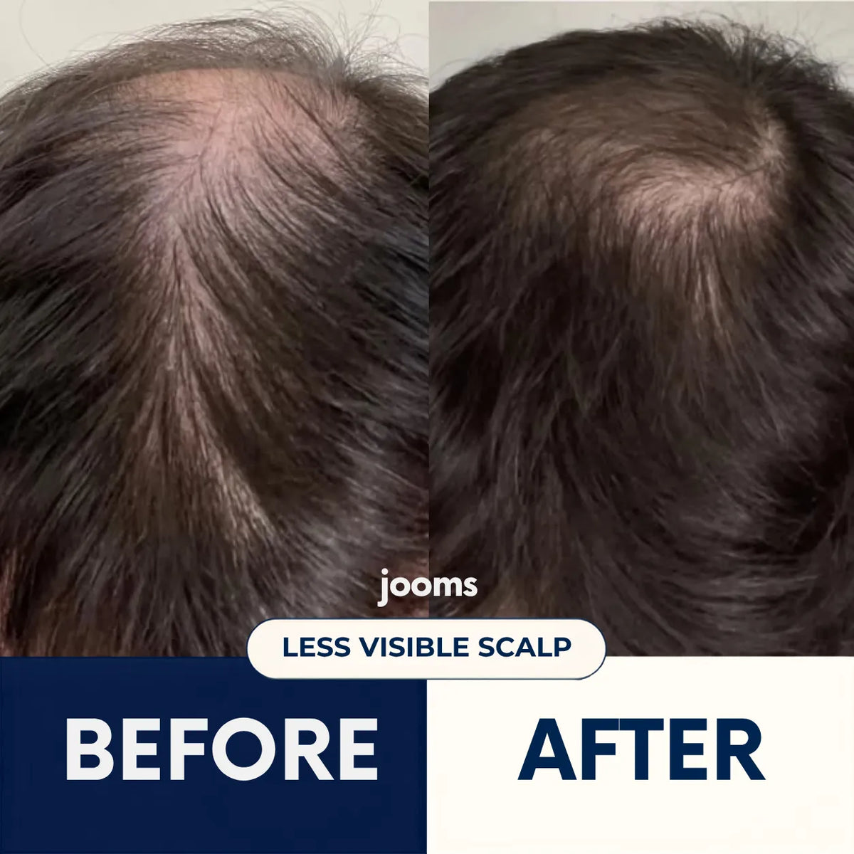 Jooms™ 2% Deoxyribose Scalp Serum