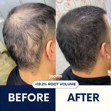 Jooms™ 2% Deoxyribose Scalp Serum