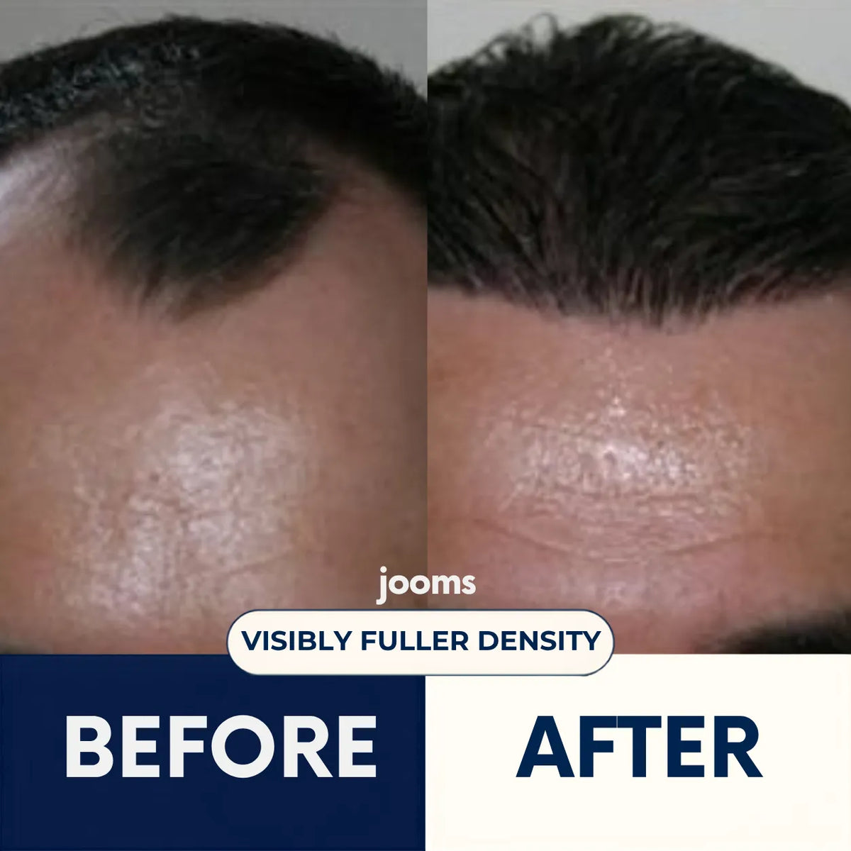 Jooms™ 2% Deoxyribose Scalp Serum