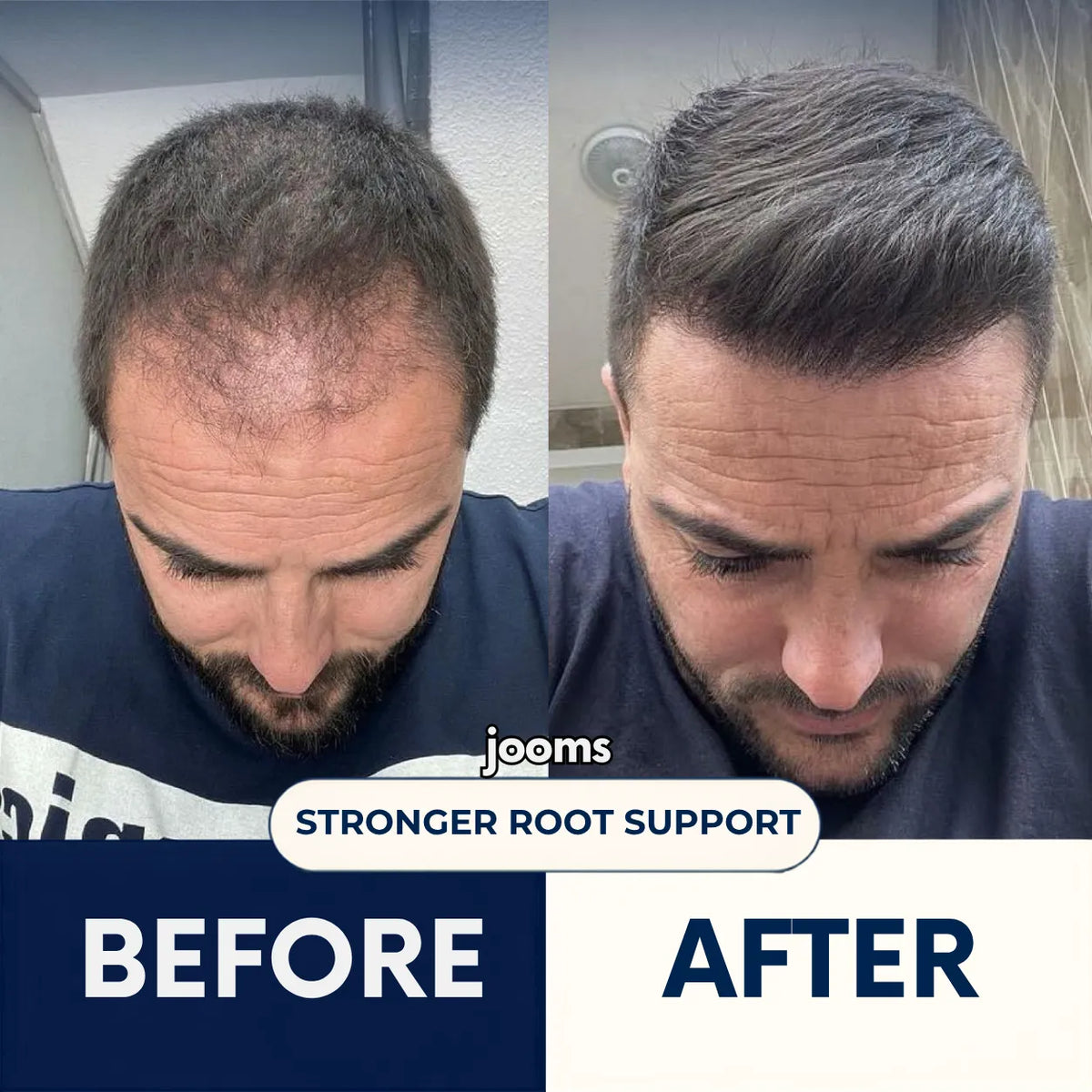 Jooms™ 2% Deoxyribose Scalp Serum